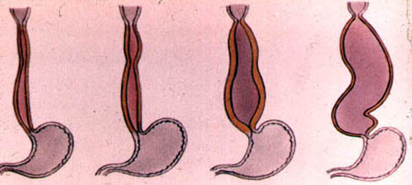 Achalasia cardia