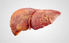 Liver Cancer